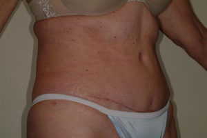 Abdominoplasty (tummy tuck)