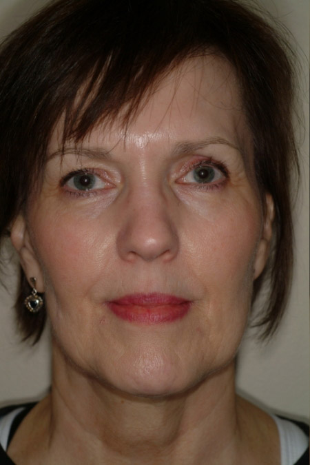 Facelift and Neck Lift Before Procedure Photo