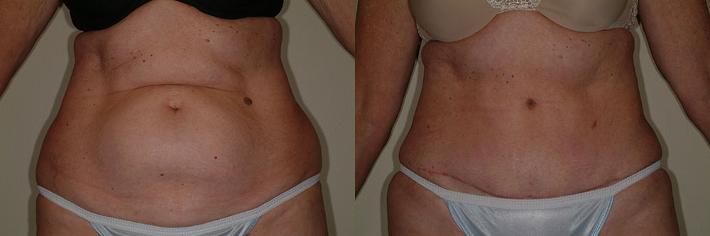 tummy tuck abdominoplasty before and after photos by remington plastic surgery in kirkland wa