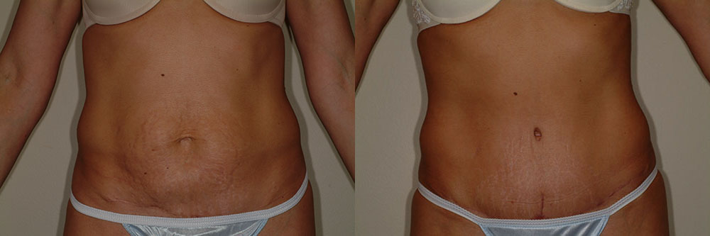 tummy tuck abdominoplasty before and after photos by remington plastic surgery in kirkland wa