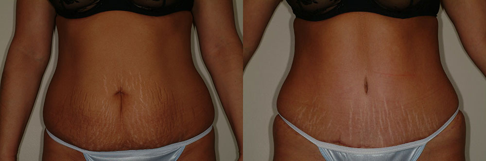 tummy tuck abdominoplasty before and after photos by remington plastic surgery in kirkland wa