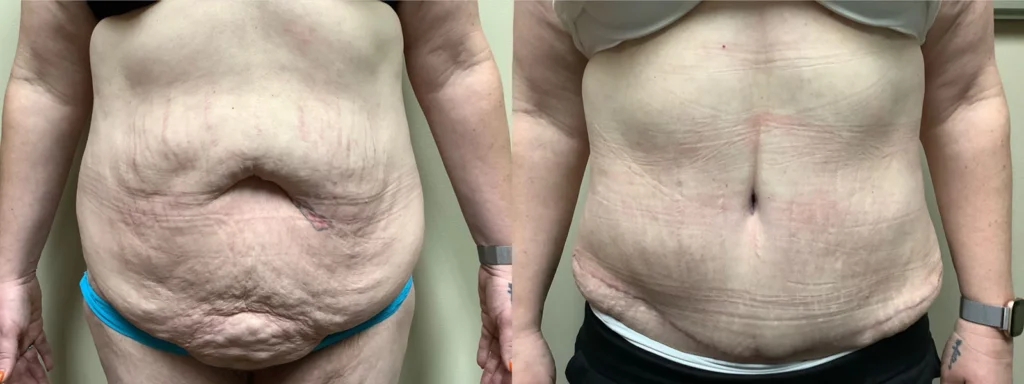 tummy tuck abdominoplasty before and after photos by remington plastic surgery in kirkland wa