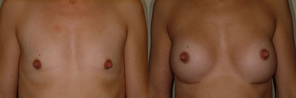 breast augmentation before and after photos by remington plastic surgery in kirkland wa