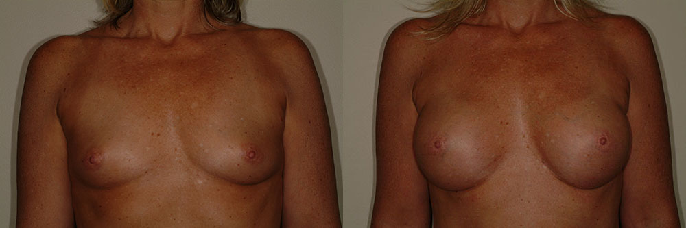 breast augmentation before and after photos by remington plastic surgery in kirkland wa