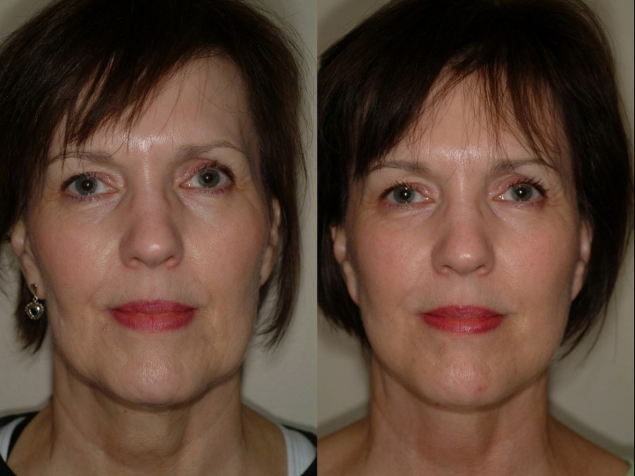 face and neck lift before and after photos by remington plastic surgery in kirkland wa