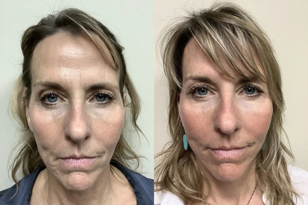 face and neck lift before and after photos by remington plastic surgery in kirkland wa