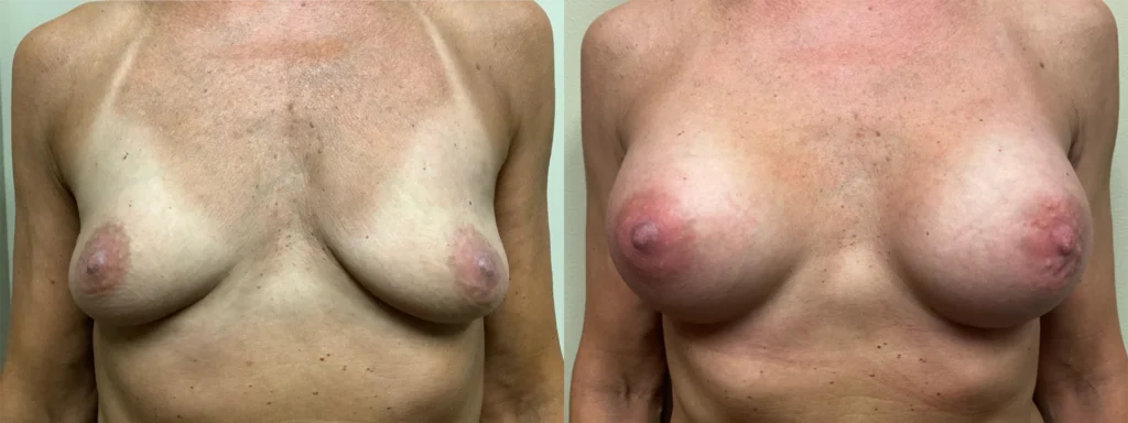 breast augmentation before and after photos by remington plastic surgery in kirkland wa