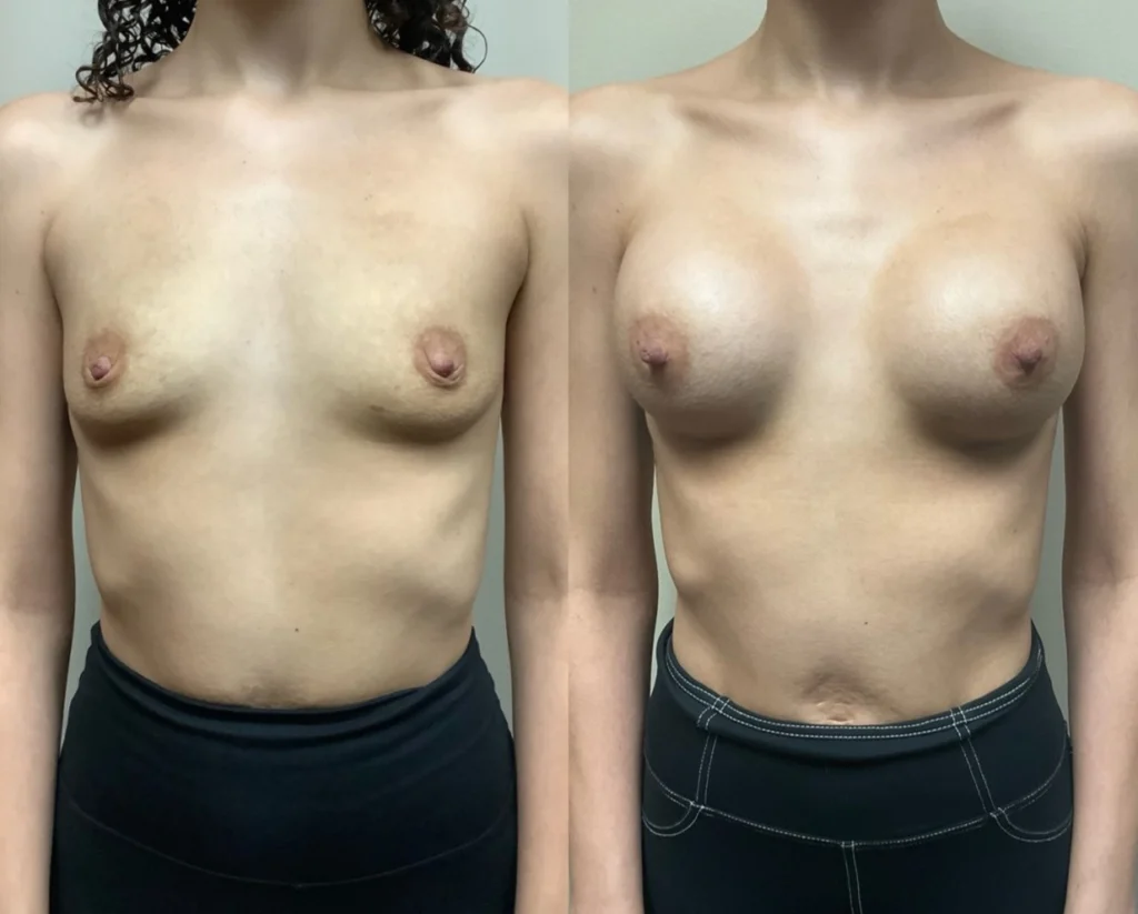 breast augmentation before and after photos by remington plastic surgery in kirkland wa