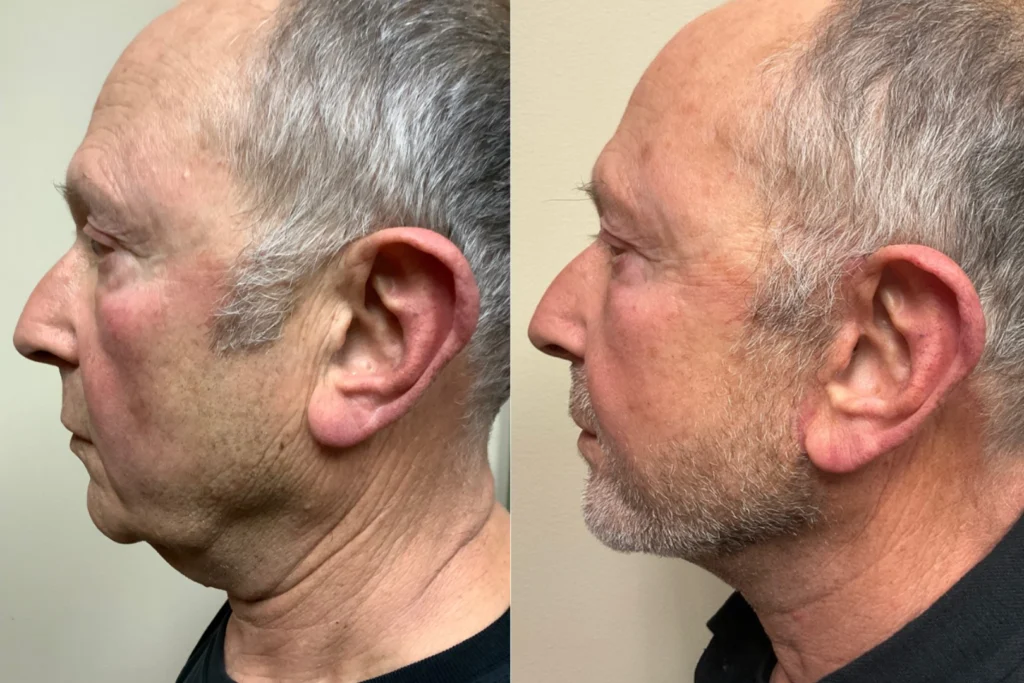 face and neck lift before and after photos by remington plastic surgery in kirkland wa