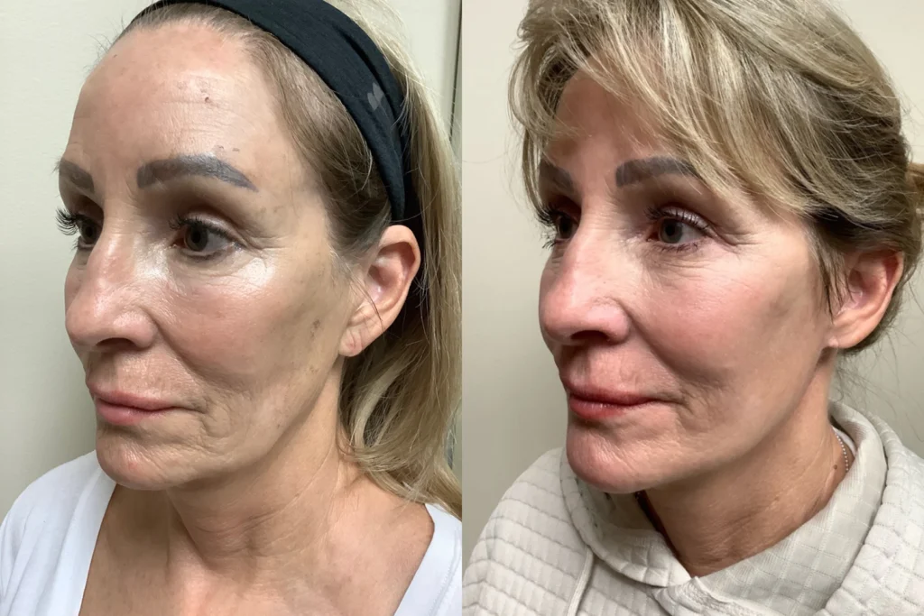 face and neck lift before and after photos by remington plastic surgery in kirkland wa