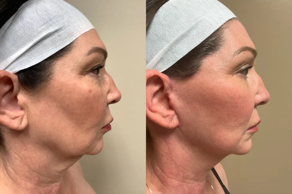 face and neck lift before and after photos by remington plastic surgery in kirkland wa