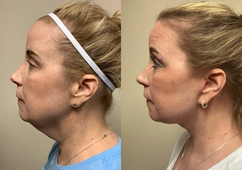 face and neck lift before and after photos by remington plastic surgery in kirkland wa
