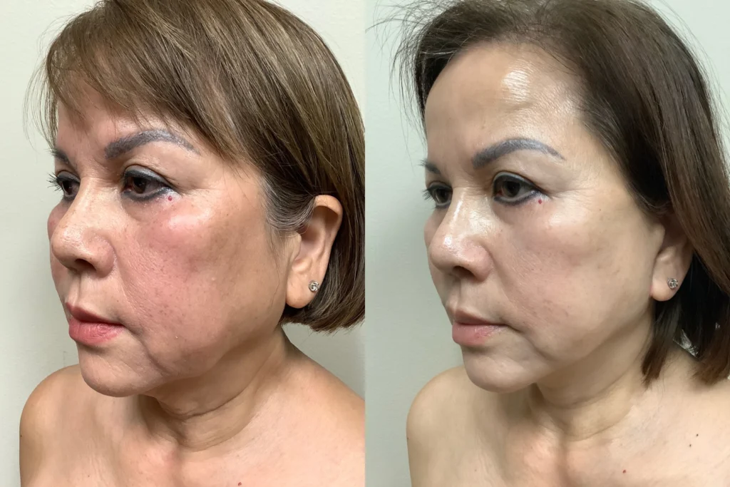face and neck lift before and after photos by remington plastic surgery in kirkland wa