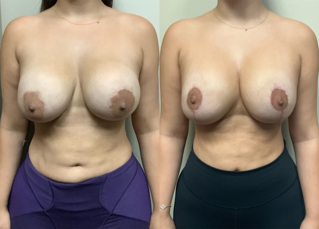 breast implant revision before and after photos by remington plastic surgery in kirkland wa