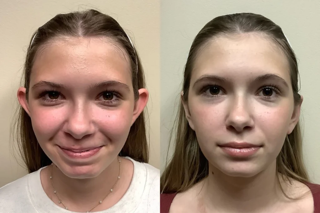 ear surgery before and after photos by remington plastic surgery in kirkland wa