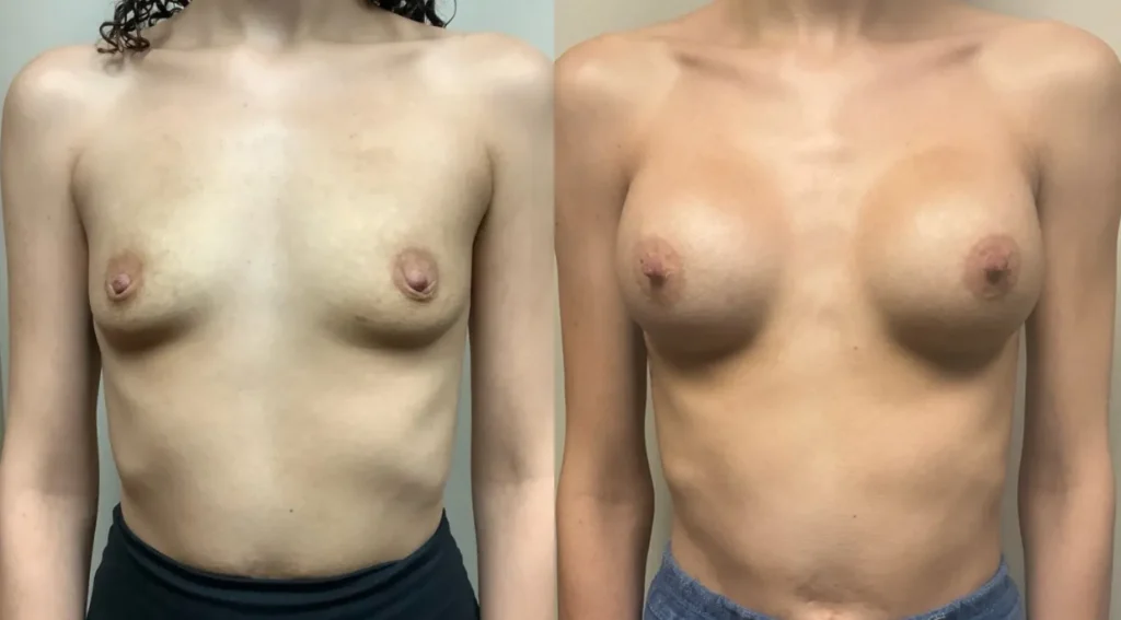 front view breast augmentation before and after photos by Remington Plastic Surgery