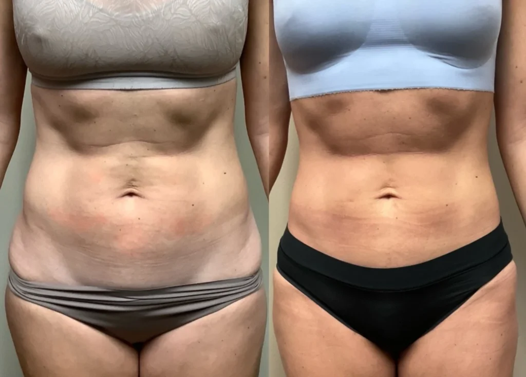 liposuction before and after photos by remington plastic surgery in kirkland wa