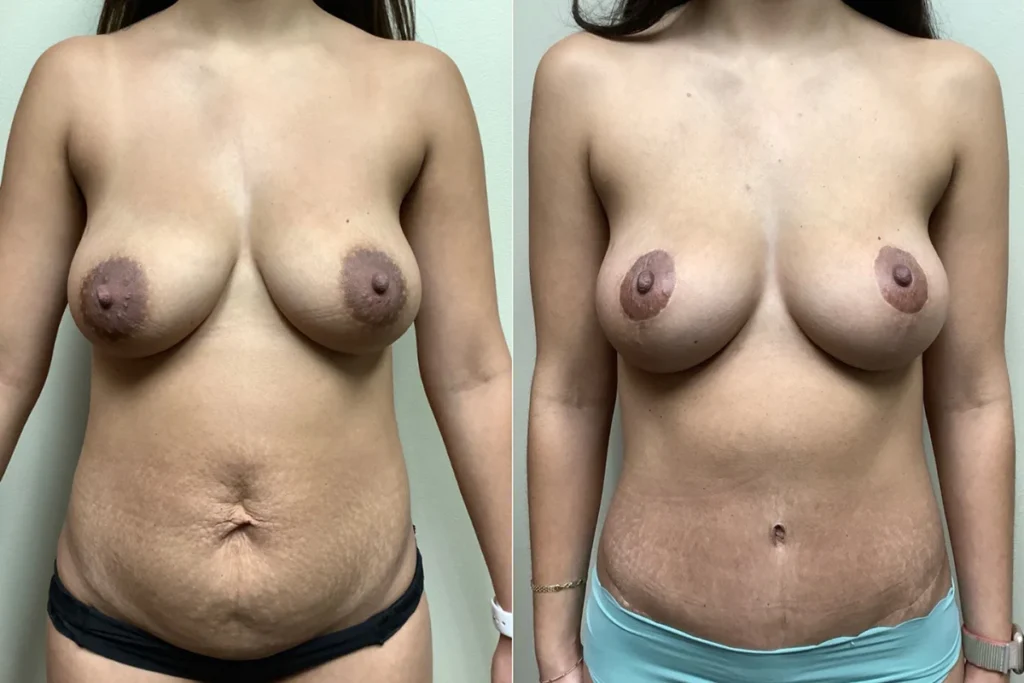 mommy makeover before and after photos by remington plastic surgery in kirkland wa