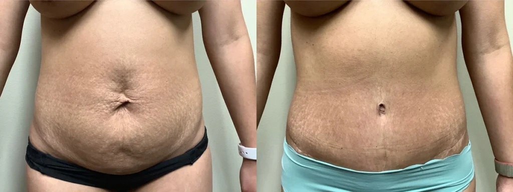 tummy tuck before and after photos by remington plastic surgery in kirkland wa