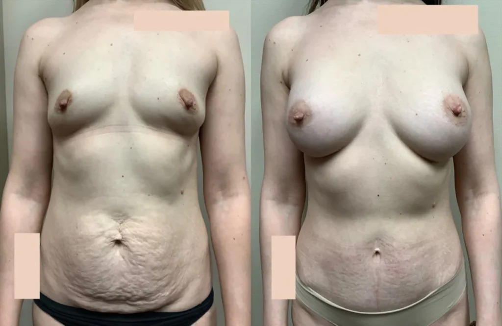 mommy makeover before and after photos by remington plastic surgery in kirkland wa