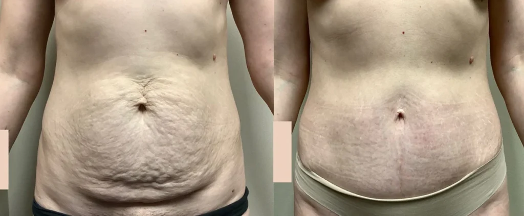 tummy tuck before and after photos by remington plastic surgery in kirkland wa