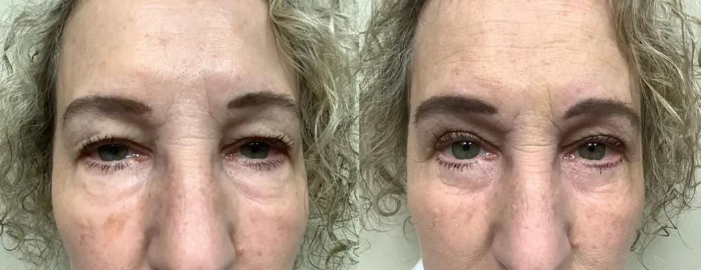 eyelid surgery before and after photos by Remington Plastic Surgery in Kirkland WA
