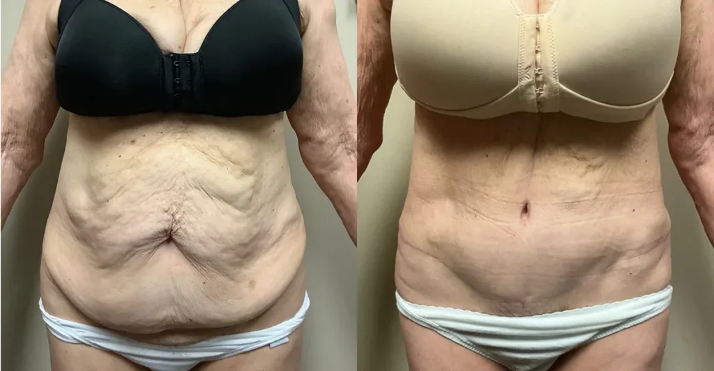 tummy tuck before and after photos by Remington Plastic Surgery in Kirkland WA