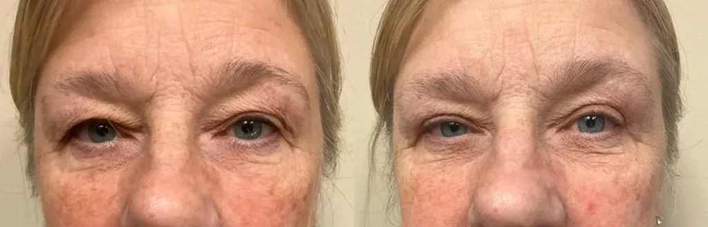 eyelid surgery before and after photos by Remington Plastic Surgery in Kirkland WA