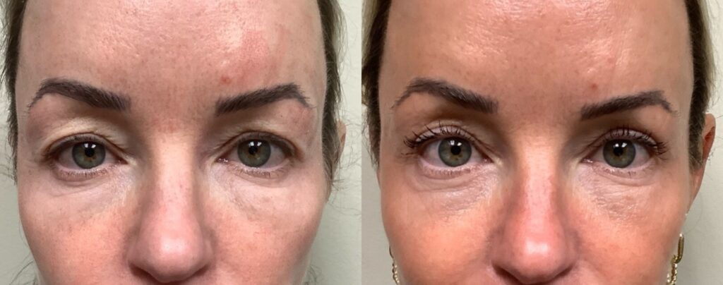 eyelid lift before and after photos by remington plastic surgery in kirkland wa