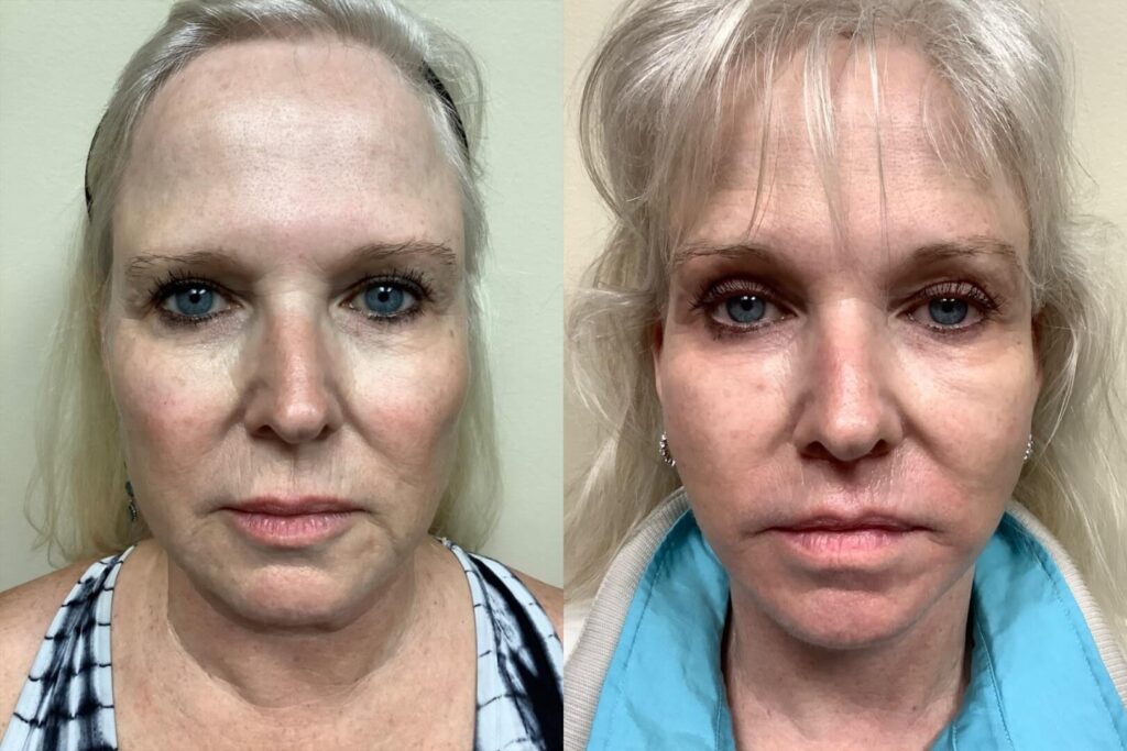 face neck lift before and after photos by remington plastic surgery in kirkland wa