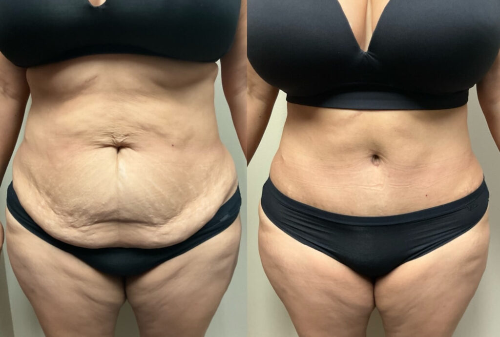 tummy tuck before and after photos by remington plastic surgery in kirkland wa