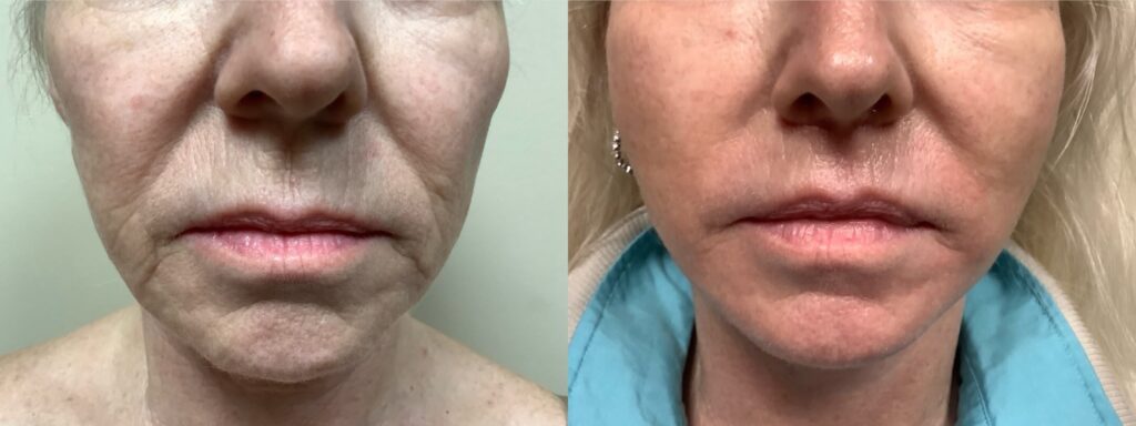 Face and Neck surgery before and after photos by Remington Plastic Surgery in Kirkland WA