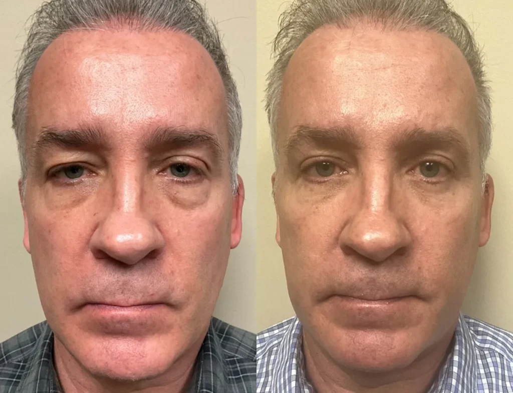 bm eyelid surgery before and after photos by Remington Plastic Surgery in Kirkland WA