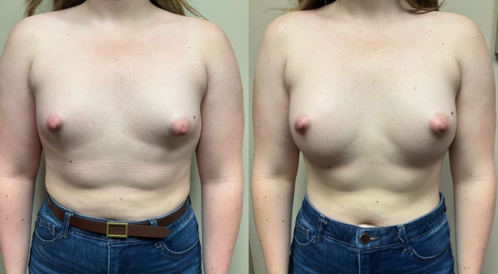 breast augmentation before and after photos by Remington Plastic Surgery in Kirkland WA