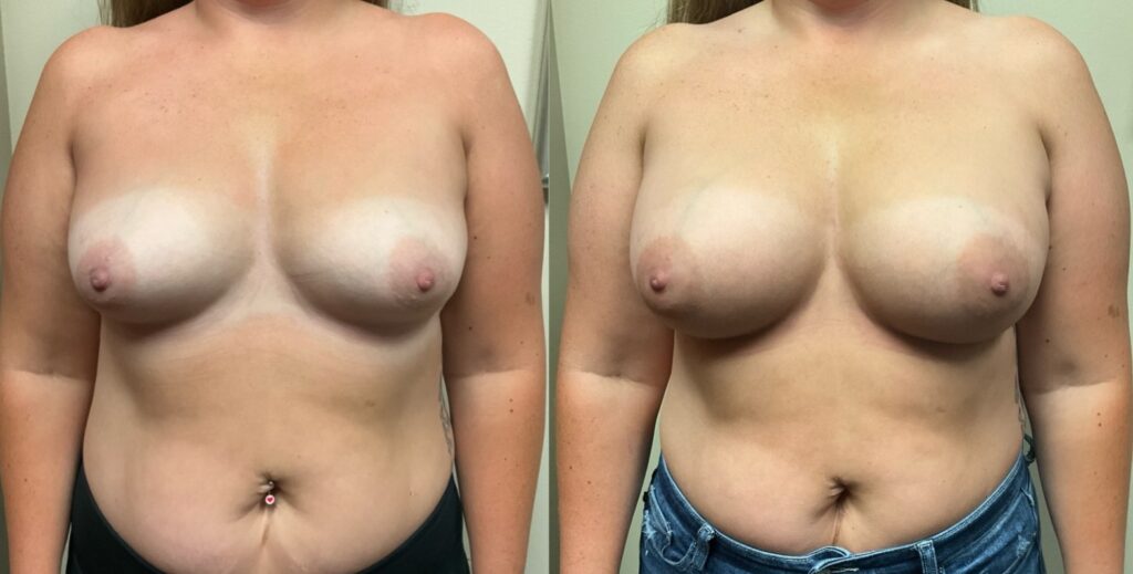 breast augmentation before and after photos by Remington Plastic Surgery in Kirkland WA
