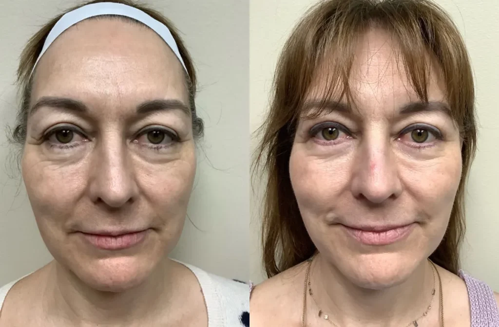 pc face and neck lift before and after photos by Remington Plastic Surgery in Kirkland WA