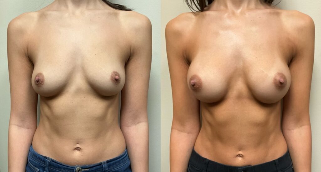 breast augmentation before and after photos by Remington Plastic Surgery in Kirkland WA