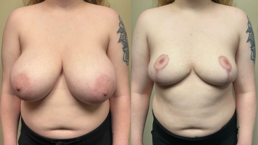 breast reduction before and after photos by Remington Plastic Surgery in Kirkland WA