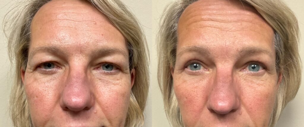 eyelid surgery before and after photos by Remington Plastic Surgery in Kirkland WA