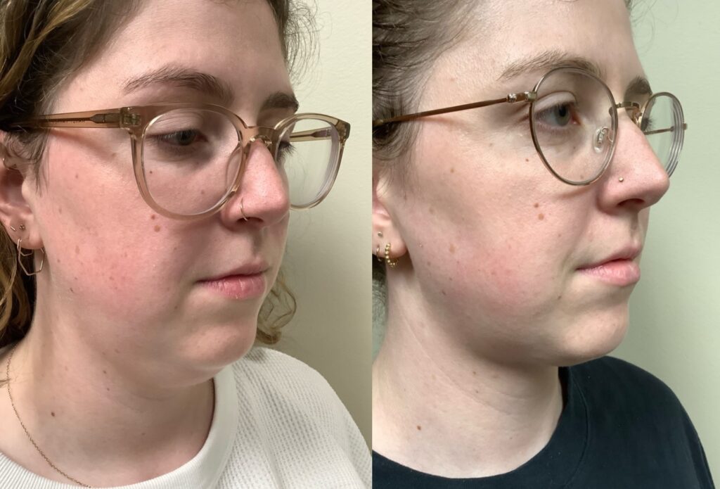 liposuction before and after photos by Remington Plastic Surgery in Kirkland WA