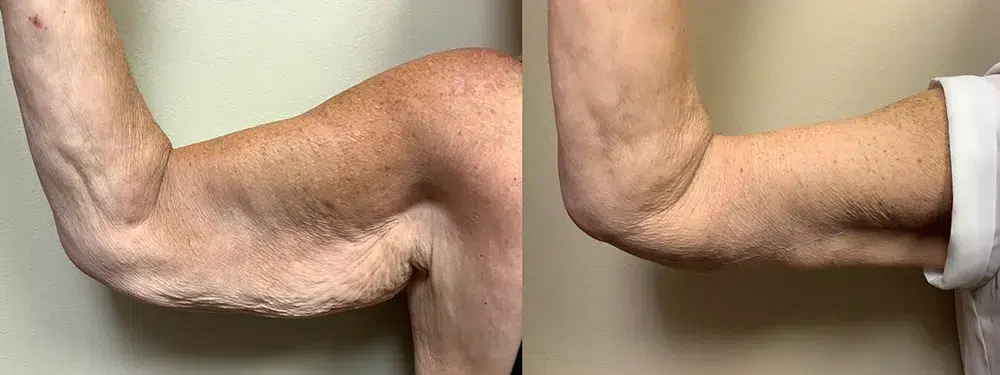 lw arm lift before and after photos by Remington Plastic Surgery in Kirkland WA