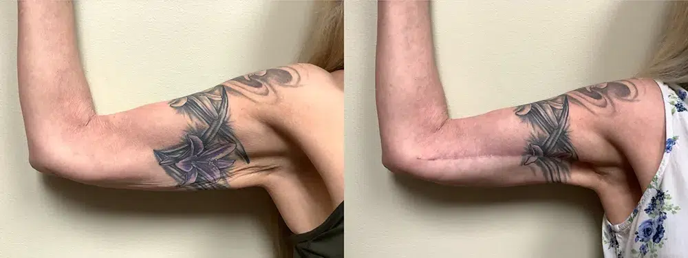 mh arm lift before and after photos by Remington Plastic Surgery in Kirkland WA