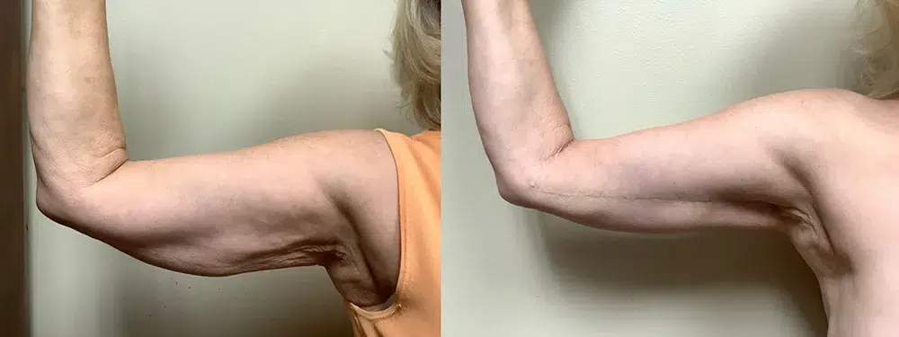 ml arm lift before and after photos by Remington Plastic Surgery in Kirkland WA