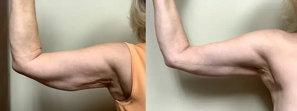 ml arm lift before and after photos by Remington Plastic Surgery in Kirkland WA