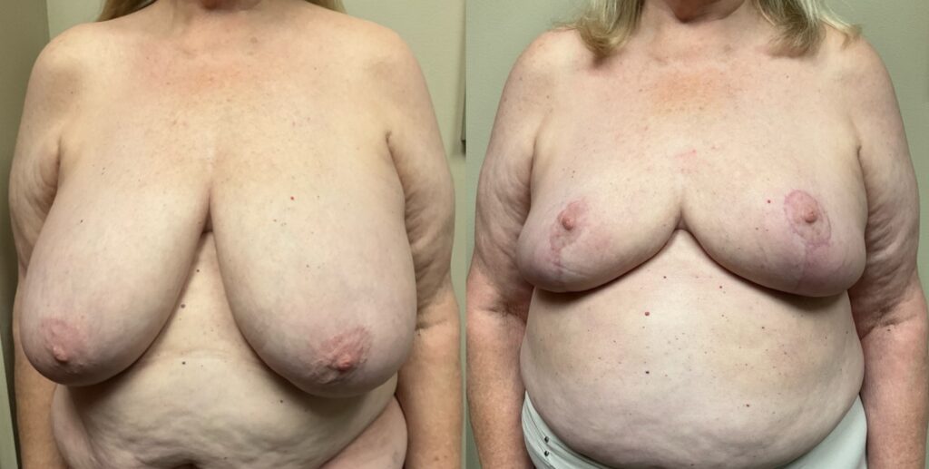 pc breast reduction before and after photos by Remington Plastic Surgery in Kirkland WA