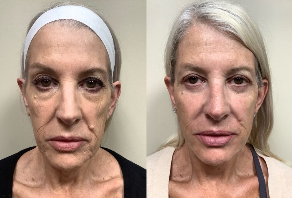 pc face and neck lift before and after photos by Remington Plastic Surgery in Kirkland WA