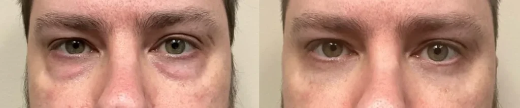 eyelid surgery before and after photos by Remington Plastic Surgery in Kirkland WA