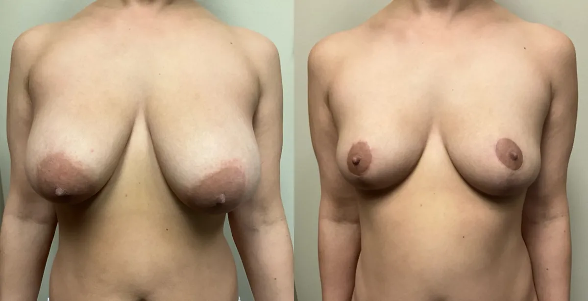 breast reduction before and after photos by Remington Plastic Surgery in Kirkland WA breast reduction before and after photos by Remington Plastic Surgery in Kirkland WA
