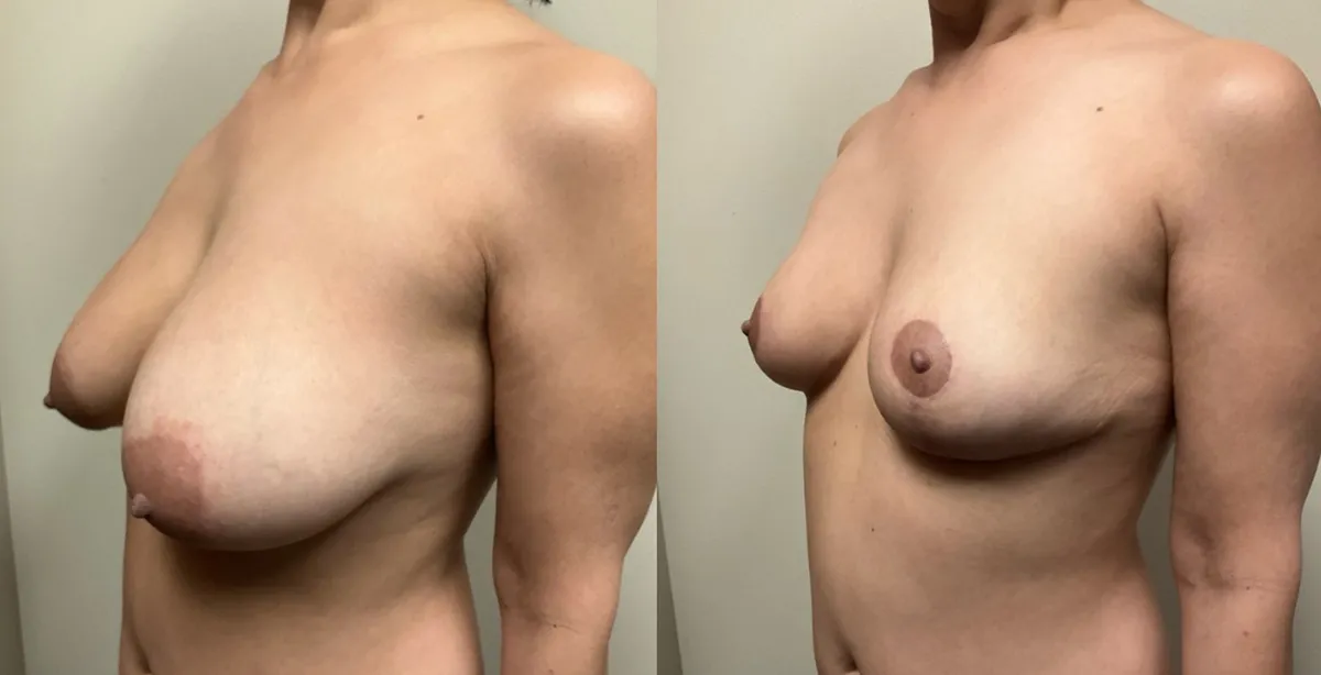 breast reduction before and after photos by Remington Plastic Surgery in Kirkland WA breast reduction before and after photos by Remington Plastic Surgery in Kirkland WA