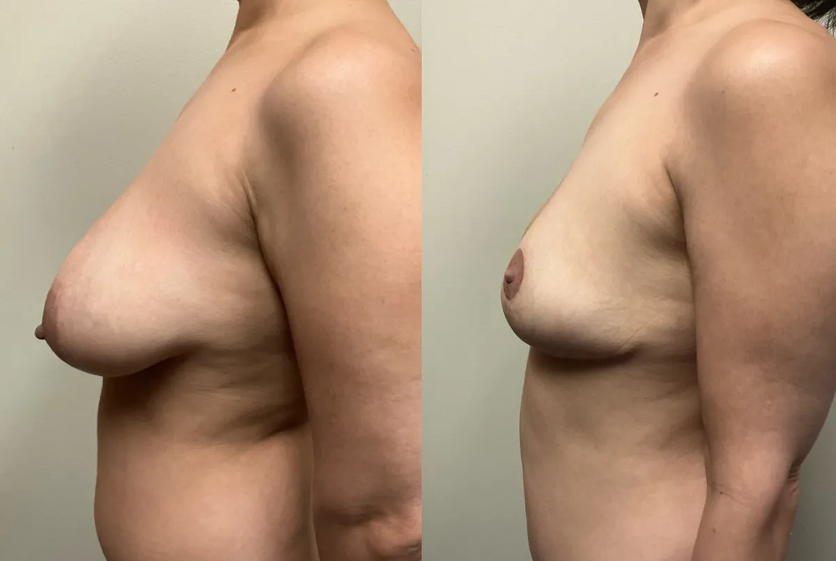 breast reduction before and after photos by Remington Plastic Surgery in Kirkland WA breast reduction before and after photos by Remington Plastic Surgery in Kirkland WA